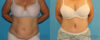 Tummy Tuck case #7172 slider thumbnail