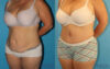 Tummy Tuck case #7172 slider thumbnail