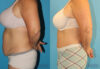 Tummy Tuck case #7172 slider thumbnail