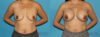 Breast Augmentation case #5649 slider thumbnail