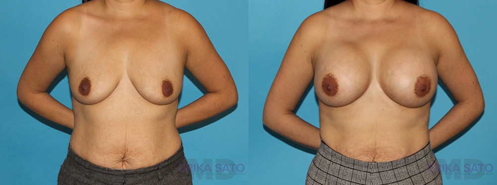 Breast Augmentation case #5649