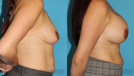 Breast Augmentation case #5649