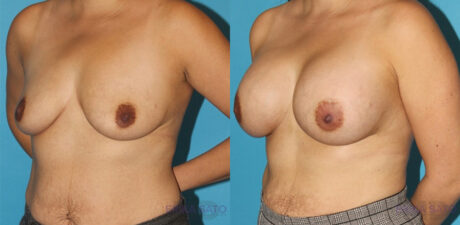 Breast Augmentation case #5649