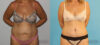 Tummy Tuck case #7228 slider thumbnail