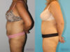 Tummy Tuck case #7228 slider thumbnail