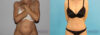 Tummy Tuck case #7164 slider thumbnail