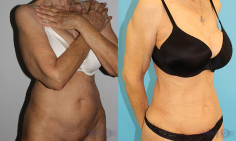Tummy Tuck case #7164