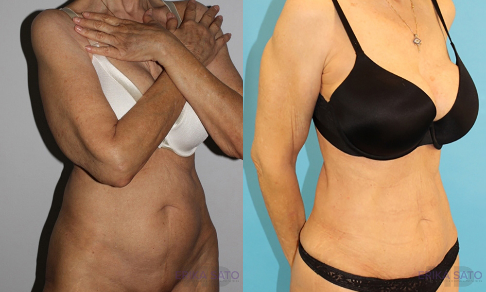 Tummy Tuck case #7164