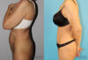 Tummy Tuck case #7164 slider thumbnail