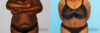 Tummy Tuck case #7084 slider thumbnail