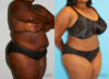 Tummy Tuck case #7084 slider thumbnail