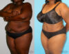 Tummy Tuck case #7084 slider thumbnail