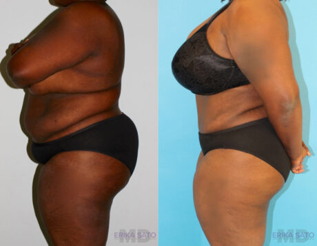 Tummy Tuck case #7084