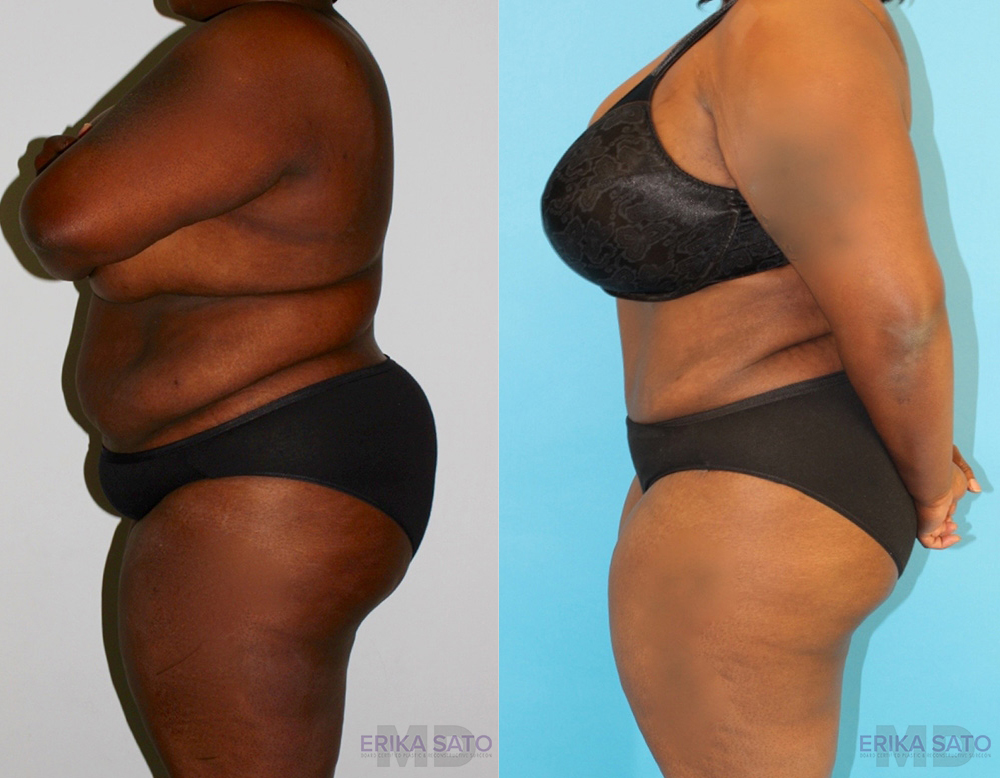 Tummy Tuck case #7084