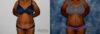 Tummy Tuck case #7082 slider thumbnail