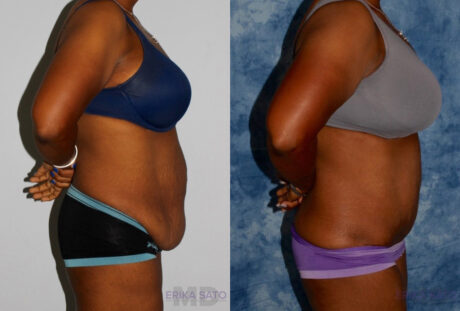 Tummy Tuck case #7082