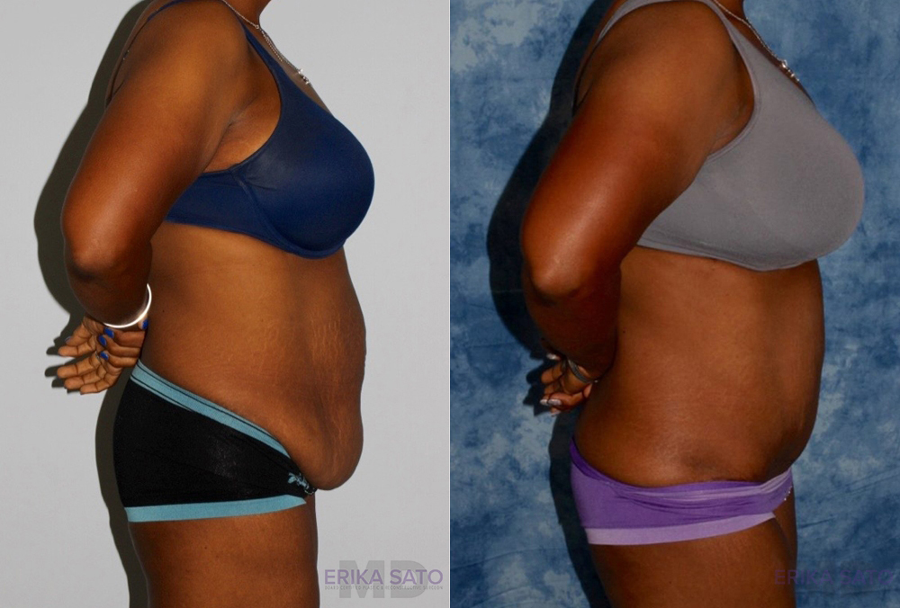 Tummy Tuck case #7082