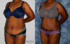 Tummy Tuck case #7082 slider thumbnail