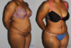 Tummy Tuck case #7083 slider thumbnail