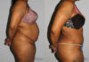 Tummy Tuck case #7083 slider thumbnail