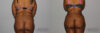 Tummy Tuck case #7083 slider thumbnail