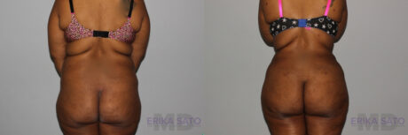 Tummy Tuck case #7083
