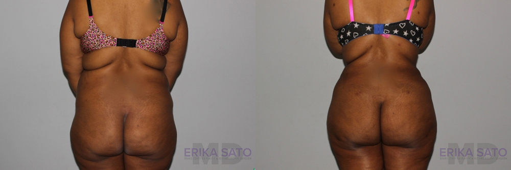 Tummy Tuck case #7083