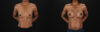 Breast Augmentation case #6485 slider thumbnail