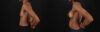 Breast Augmentation case #6485 slider thumbnail