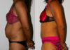 Tummy Tuck case #7081 slider thumbnail