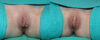 Labiaplasty case #5795 slider thumbnail
