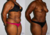 Tummy Tuck case #7089 slider thumbnail
