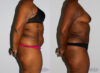 Tummy Tuck case #7089 slider thumbnail