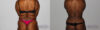 Tummy Tuck case #7089 slider thumbnail