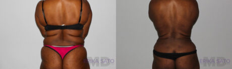 Tummy Tuck case #7089