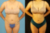 Brazilian Butt Lift case #5117 slider thumbnail