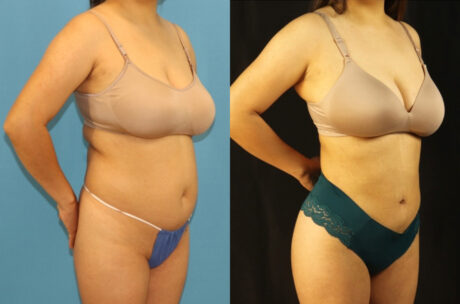 Brazilian Butt Lift case #5117