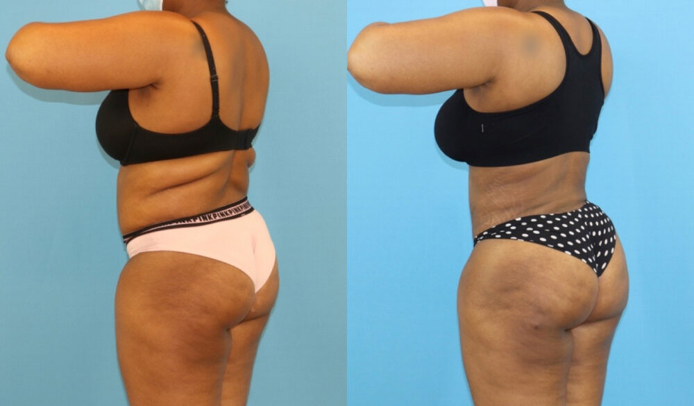Brazilian Butt Lift case #5116