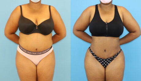 Brazilian Butt Lift case #5116
