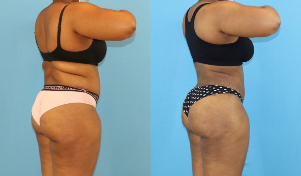 Brazilian Butt Lift case #5116