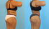 Brazilian Butt Lift case #5116 slider thumbnail
