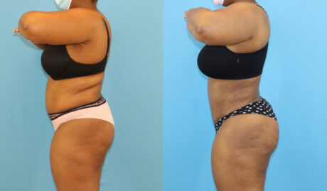 Brazilian Butt Lift case #5116