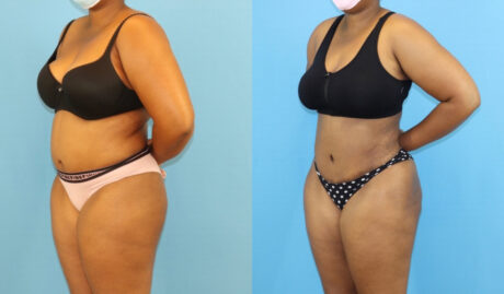 Brazilian Butt Lift case #5116