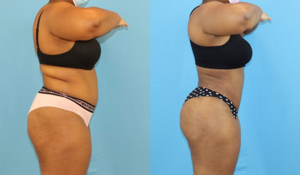 Brazilian Butt Lift case #5116