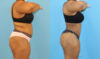 Brazilian Butt Lift case #5116 slider thumbnail