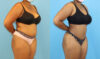 Brazilian Butt Lift case #5116 slider thumbnail