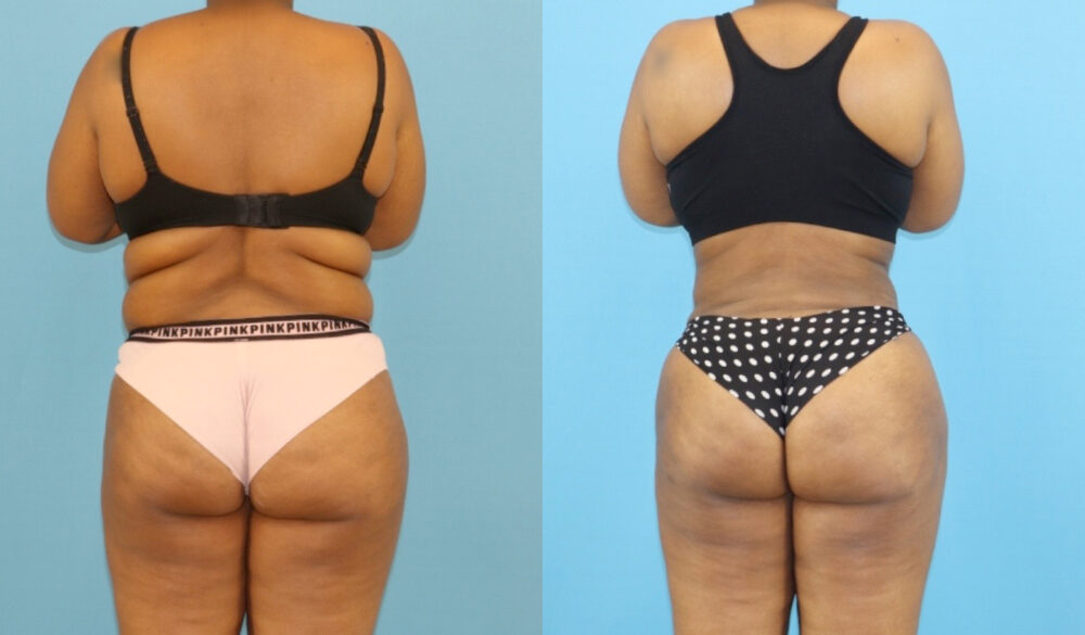 Brazilian Butt Lift case #5116