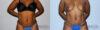 Tummy Tuck case #7080 slider thumbnail
