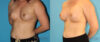 Breast Augmentation case #5644 slider thumbnail