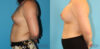 Breast Augmentation case #5644 slider thumbnail